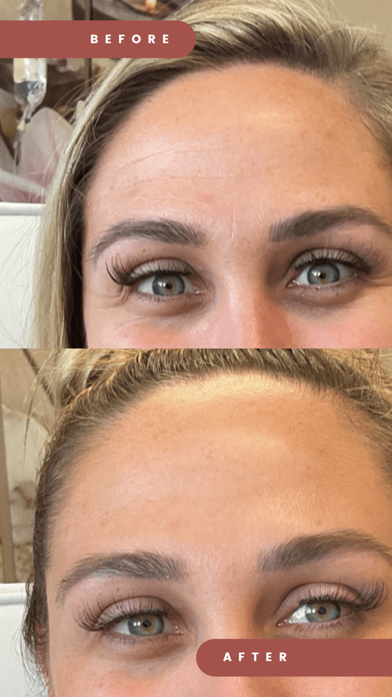 Botox Forehead Redlands