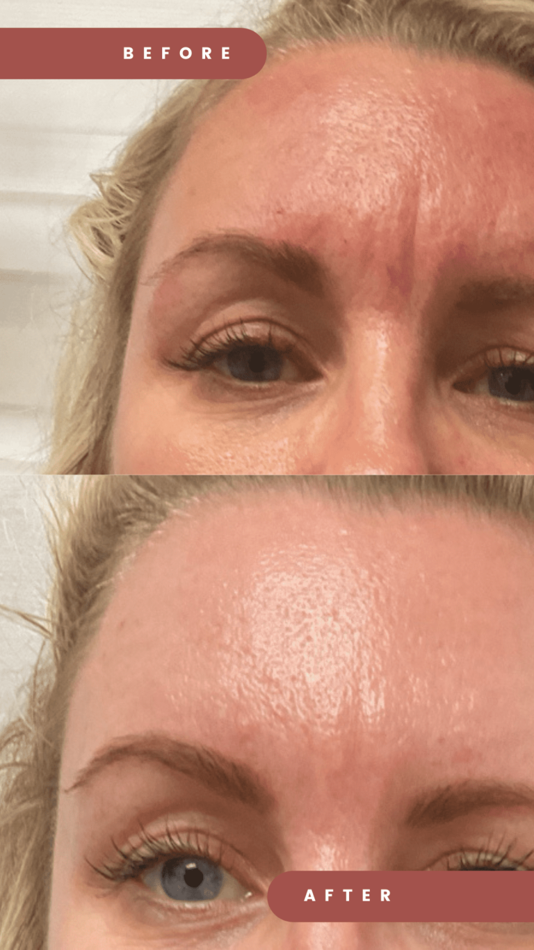 Botox elevens on forehead redlands