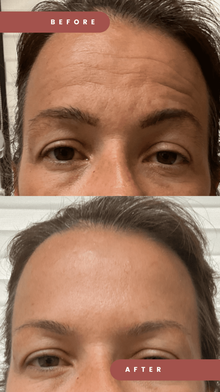 Botox Dysport Forehead Redlands Medspa