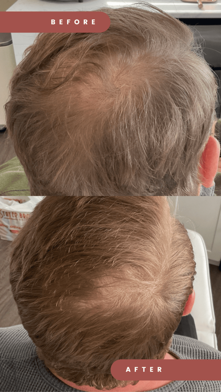 Mens PRP Hair Loss Treatment - Redlands CA