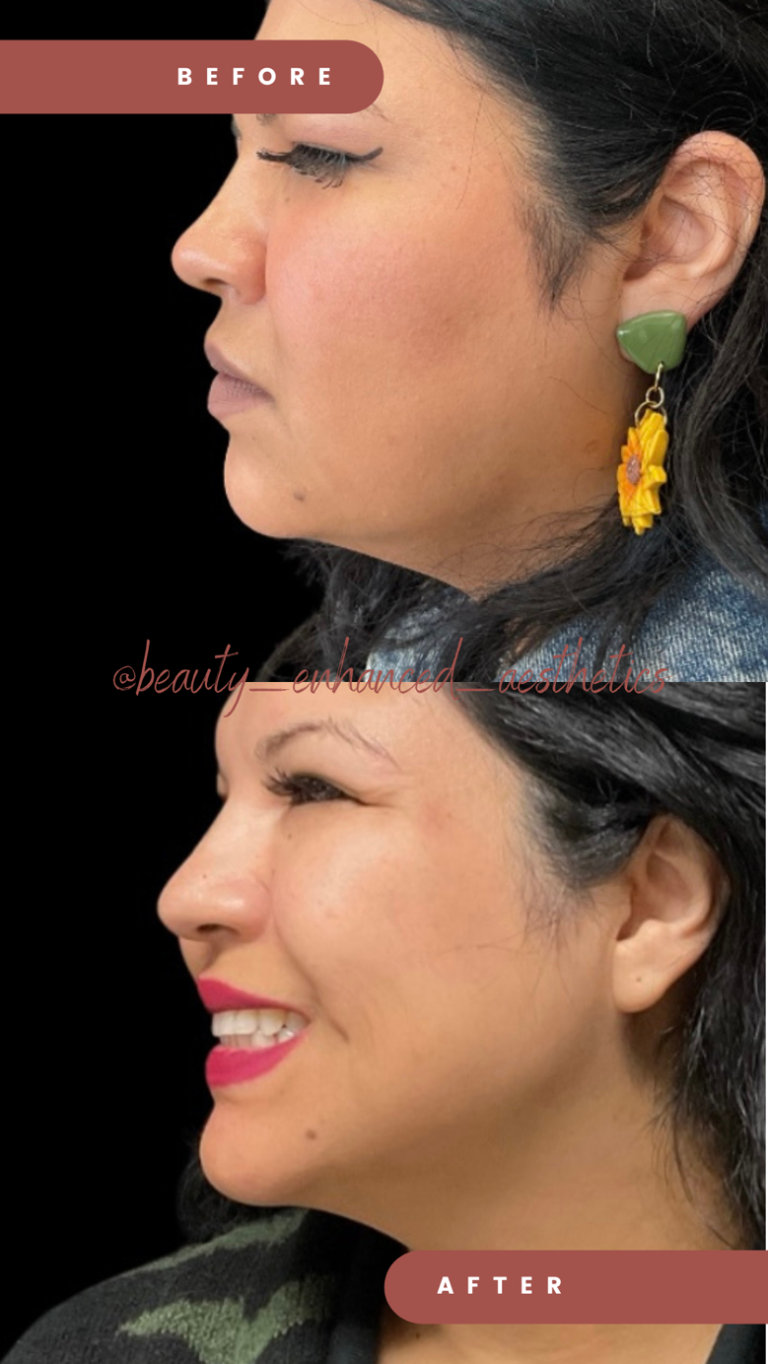 Liquid Chin Augmentation, Redlands Medspa