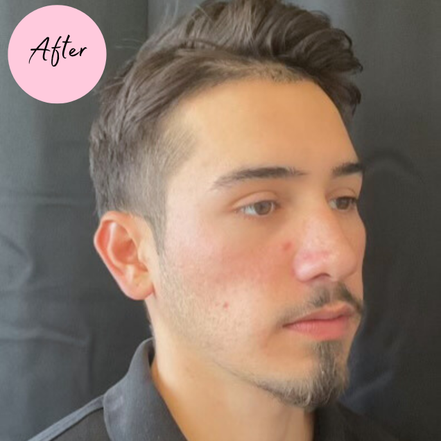 After microneedling with PRP for acne scars