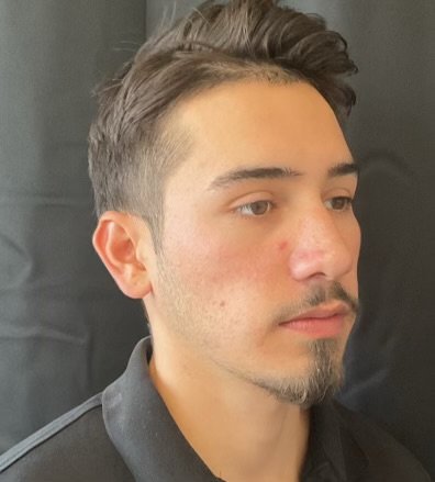 After microneedling with PRP for acne scars