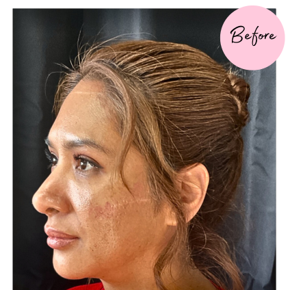 Microneedling with PRP Melasma and scarring before