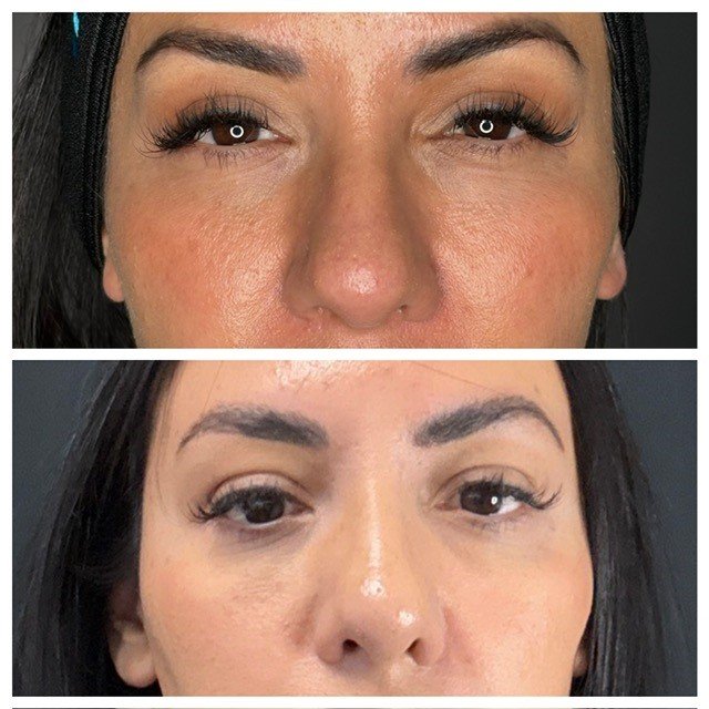 Nose Thread Lift Redlands CA