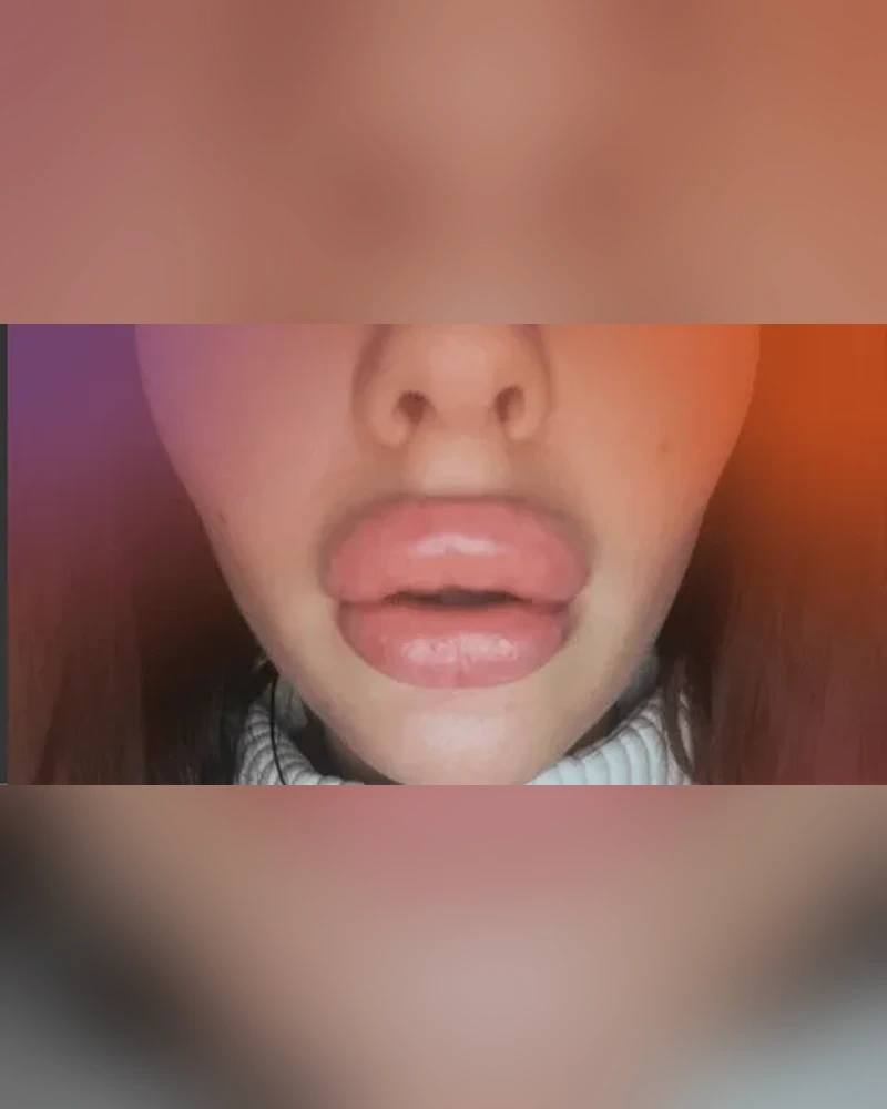 Bad-Lip-Filler-portrait (1)