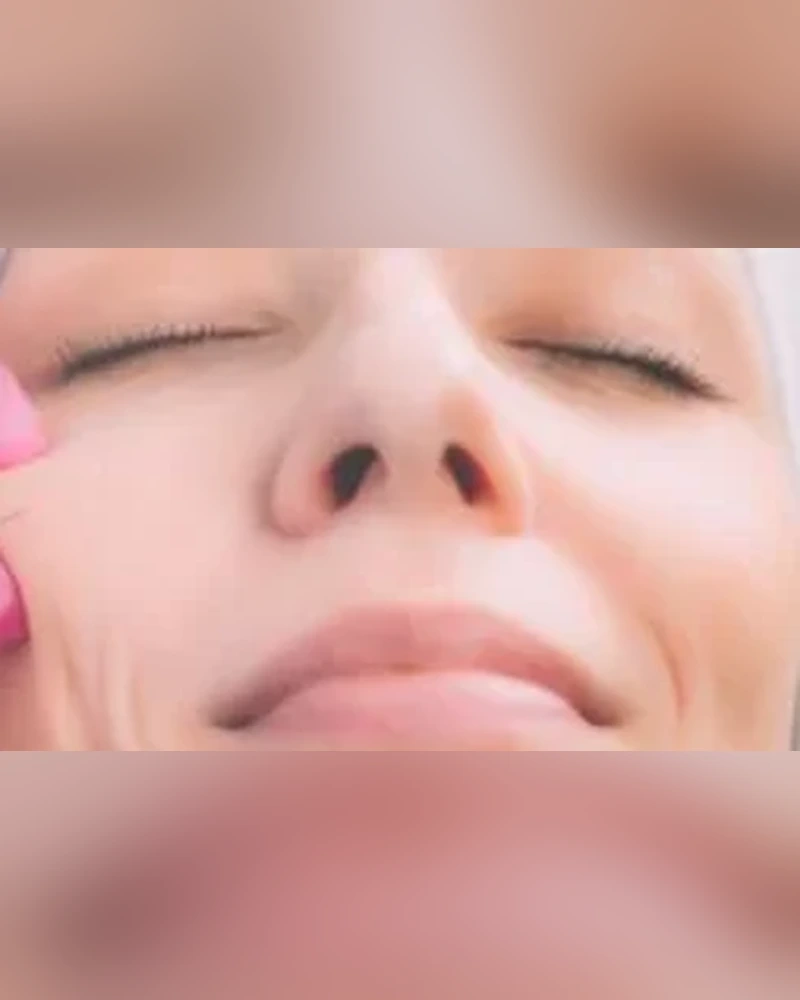 Sculptra-portrait (1)